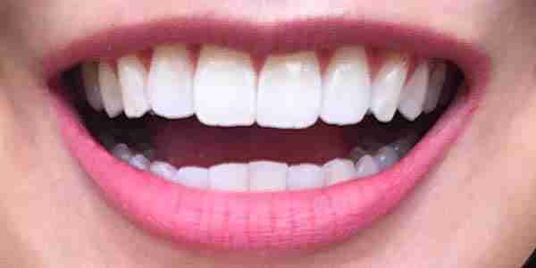 Invisalign After