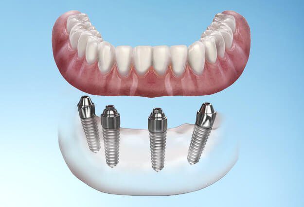 allon4-dental-implants