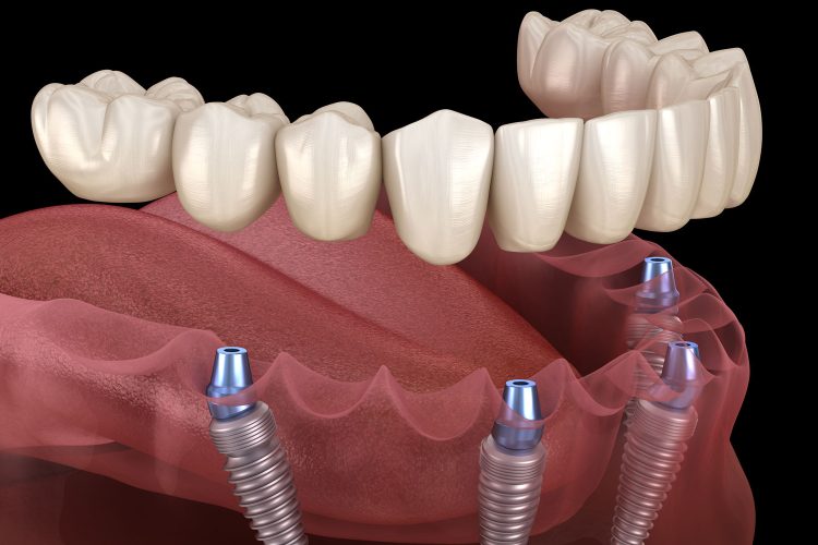 full mouth dental implants