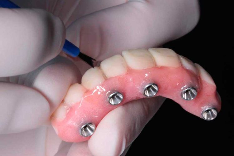 Permanent Dentures