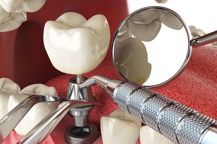 dental bridge vs implant
