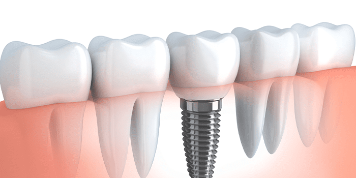 same-day dental implants